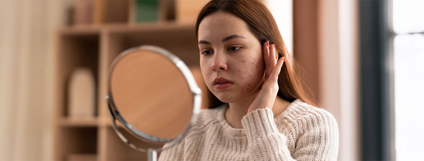 how to remove dark spots caused by pimples​